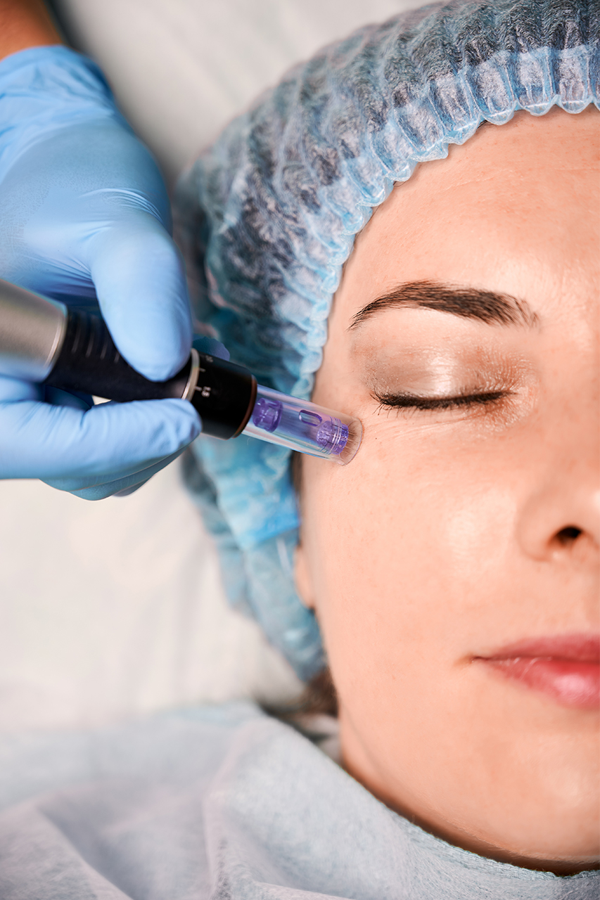 Microneedling Hover
